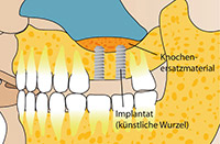 Sinuslift-Knochenaufbau